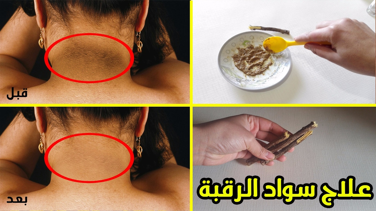 وصفة تبيض الرقبة