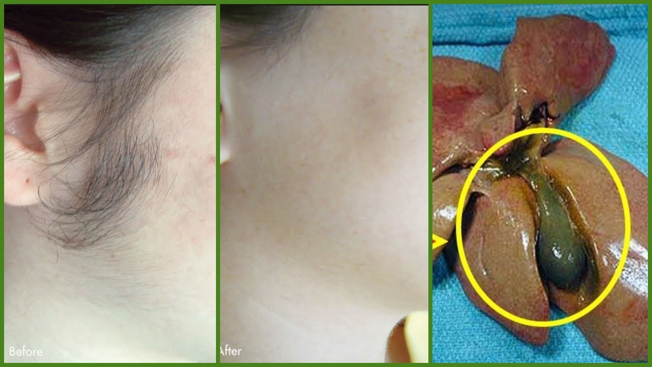 إزالة الشعر بمرارة الدجاج