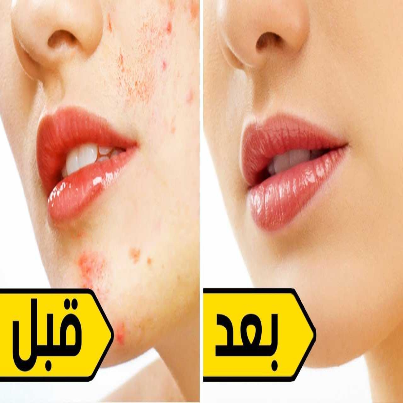وصفة التخلص من حبوب الوجه