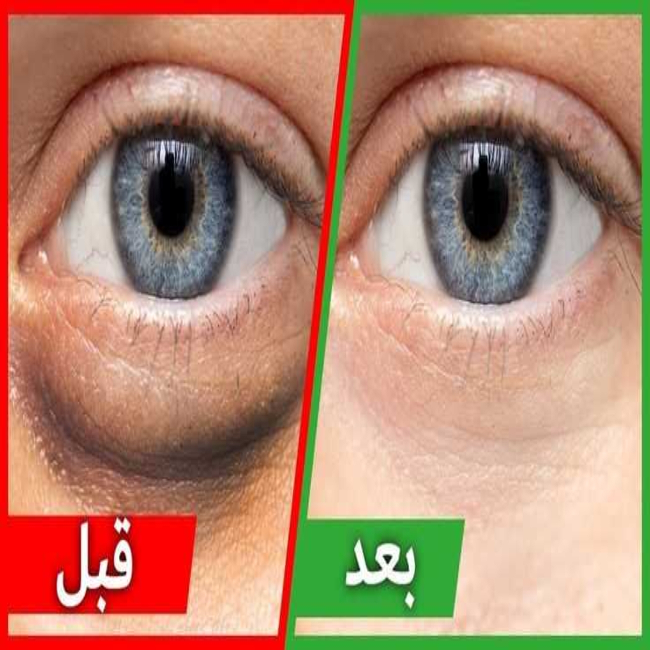 الهالات السوداء
