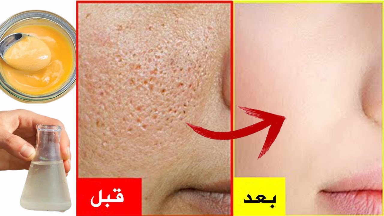 قناع ماء الورد والنشا