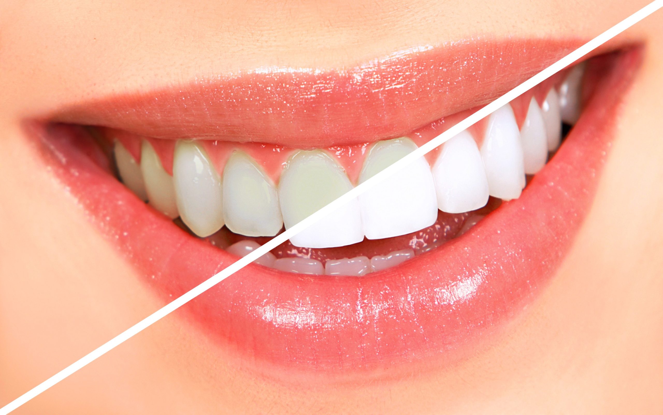 teeth whitening 3