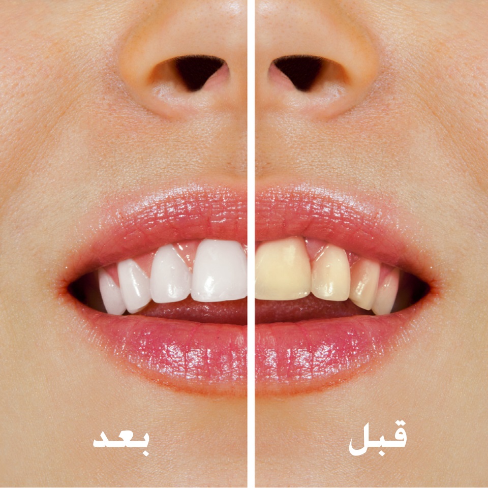 أفضل الوصفات المنزلية لتبيض الأسنان