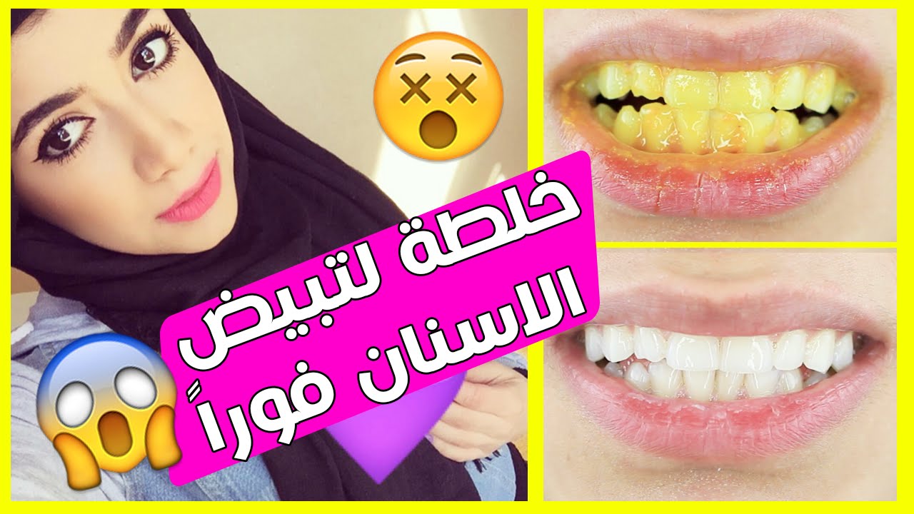تبييض الأسنان في 5 دقائق