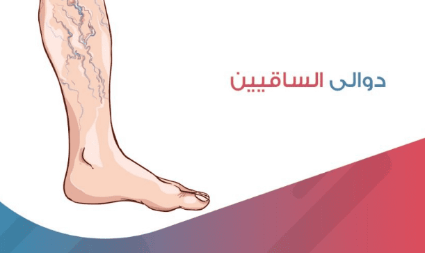 طريقة علاج الدوالي في القدم