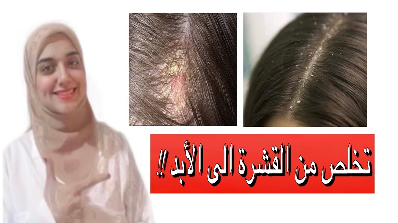 علاج قشرة الشعر بسرعة