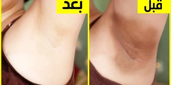 وصفات سحرية لتفتيح ولتبيض الإبطين والأماكن الداكنة