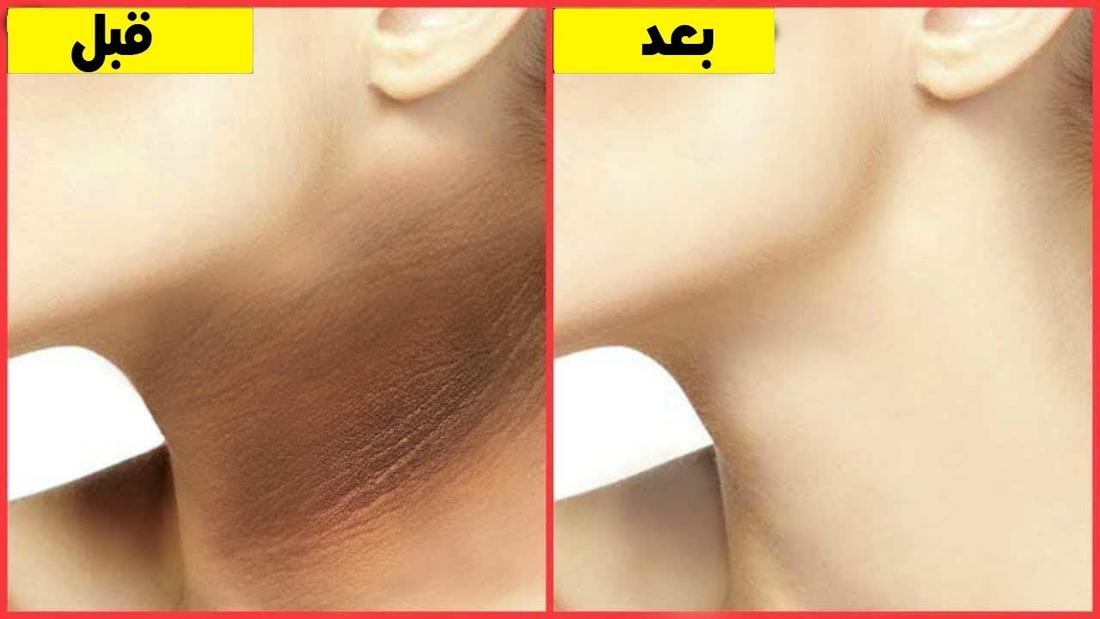 وصفة تبييض الرقبة في ربع ساعة فقط