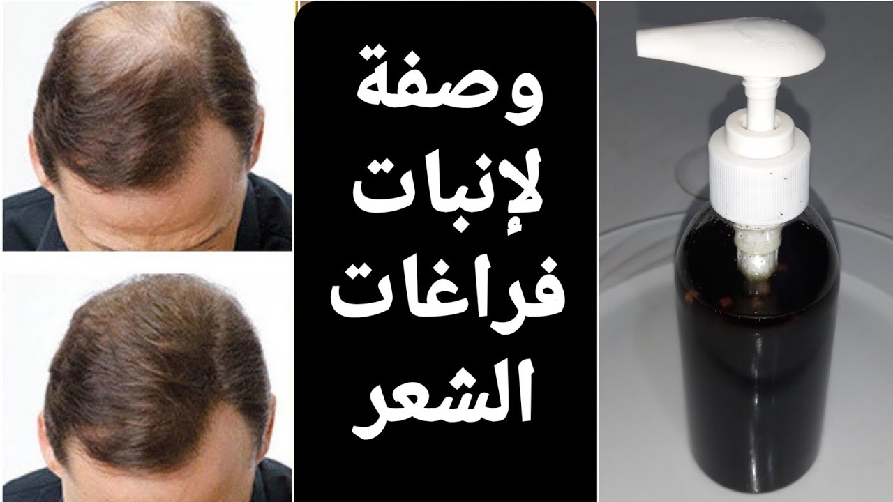 وصفة طبيعية لإنبات فراغات الشعر
