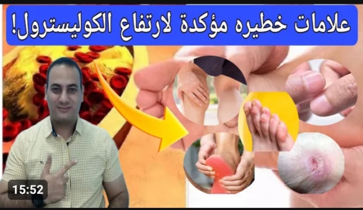 اخطر طعام يتسبب في ارتفاع الكوليسترول