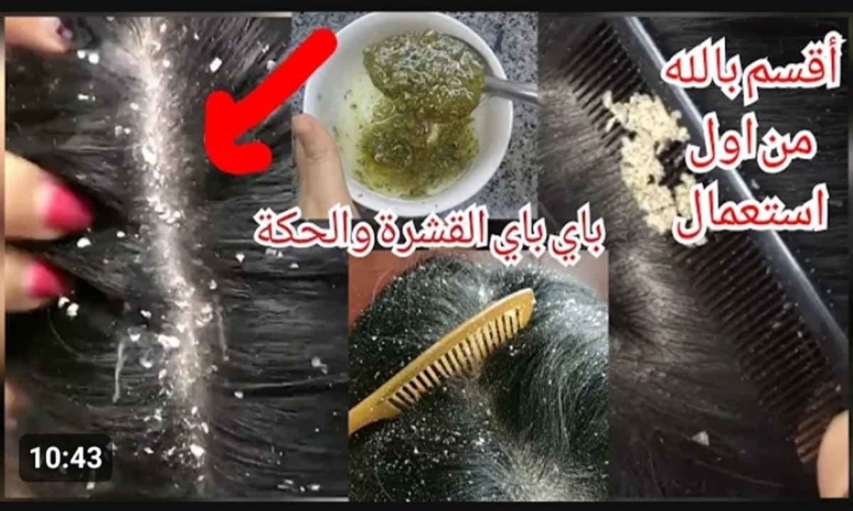 وصفات مجربة للتخلص من قشرة الشعر