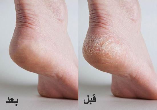 تقشير كعب رجليكي
