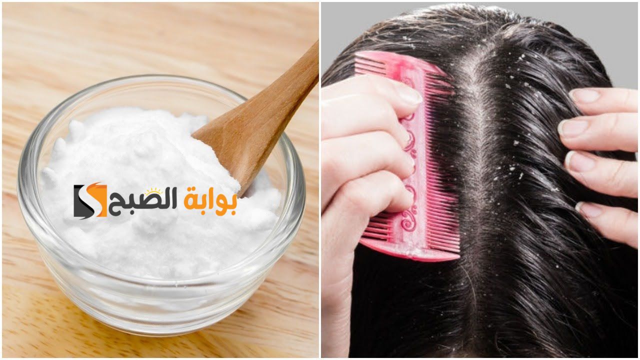 مستنية ايه طبقيها بسرعة.. مجموعة مختلفة من الوصفات للتخلص من قشرة الشعر وبشكل نهائي " مجربة وطبيعية "