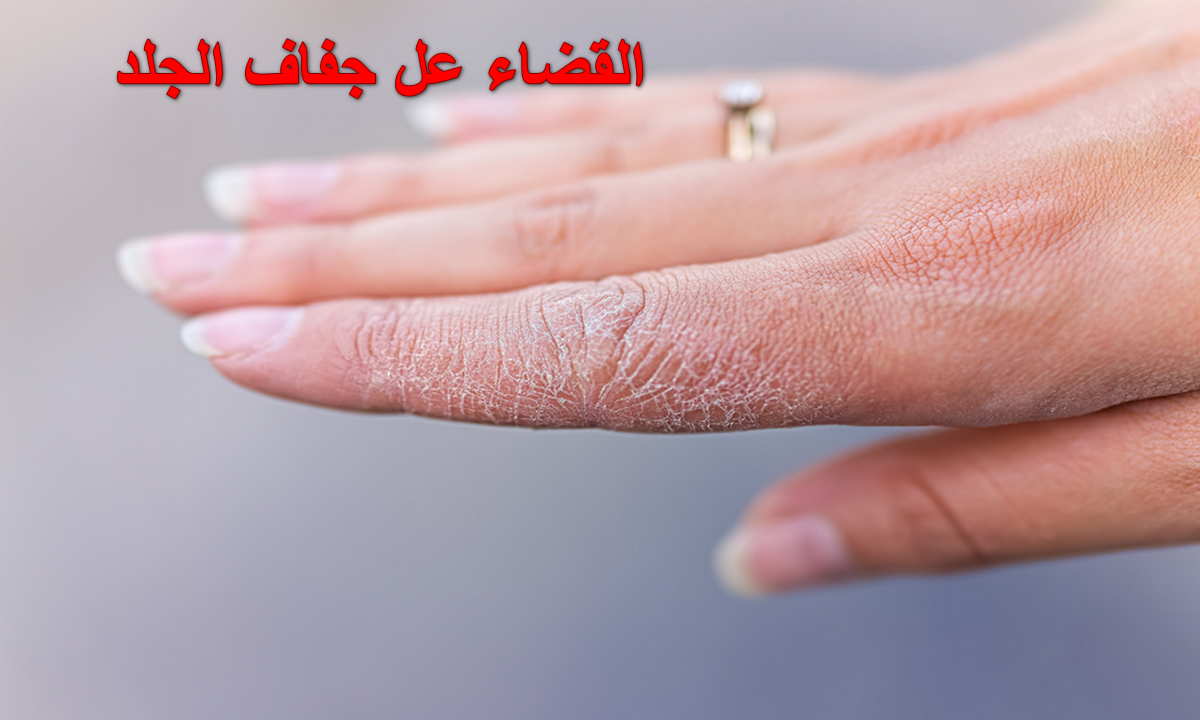 القضاء على جفاف الجلد