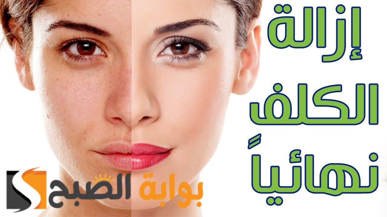وداعا لمشكلة الكلف والنمش .... وصفات طبيعية لازالة النمش والكلف نهائيا
