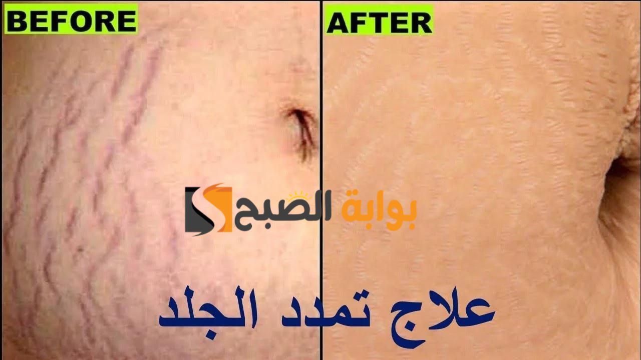 للجنس الناعم.. اعرفيها دلوقتي أسباب ظهور علامات تمدد الجلد ووسائل التخلص منها بطرق سريعة وغير مكلفة في البيت "هتشكريني عليها طول حياتك"