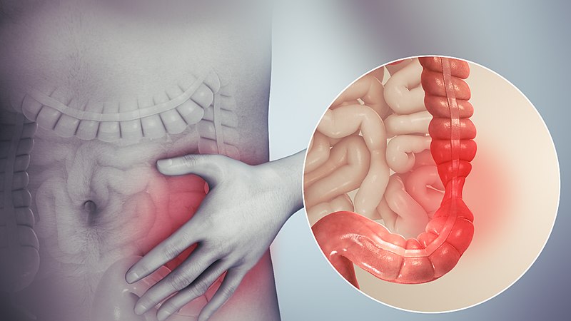 800px Irritable bowel syndrome