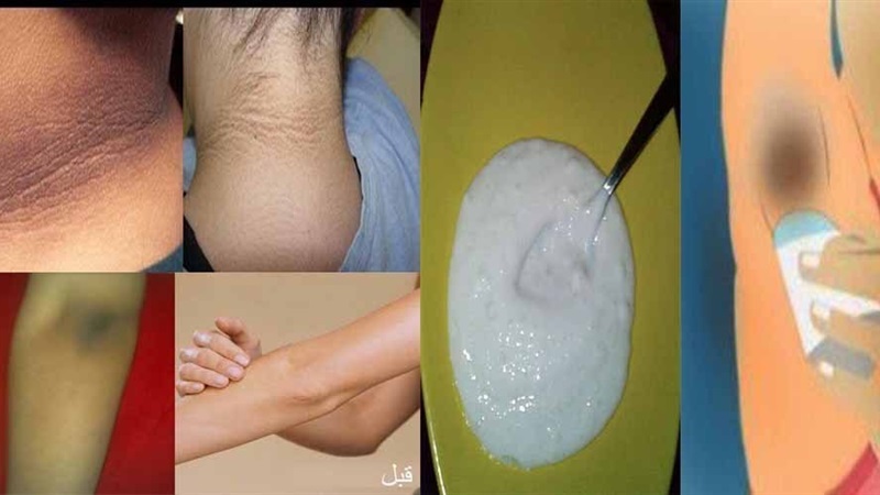 وصفة لتبيض المناطق الحساسة
