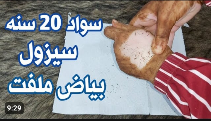 تقشير البشرة
