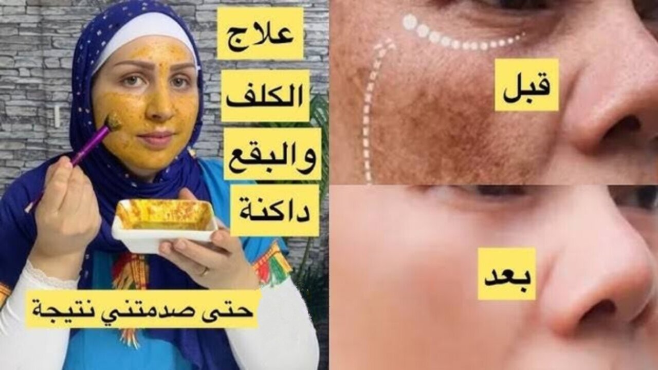 علاج الكلف بالالوفيرا
