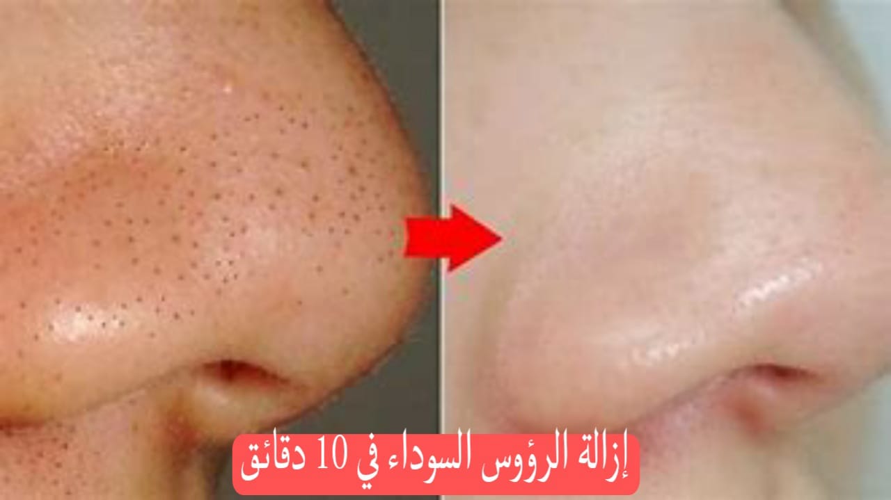 إزالة الرؤوس السوداء من الوجه في 10 دقائق فقط