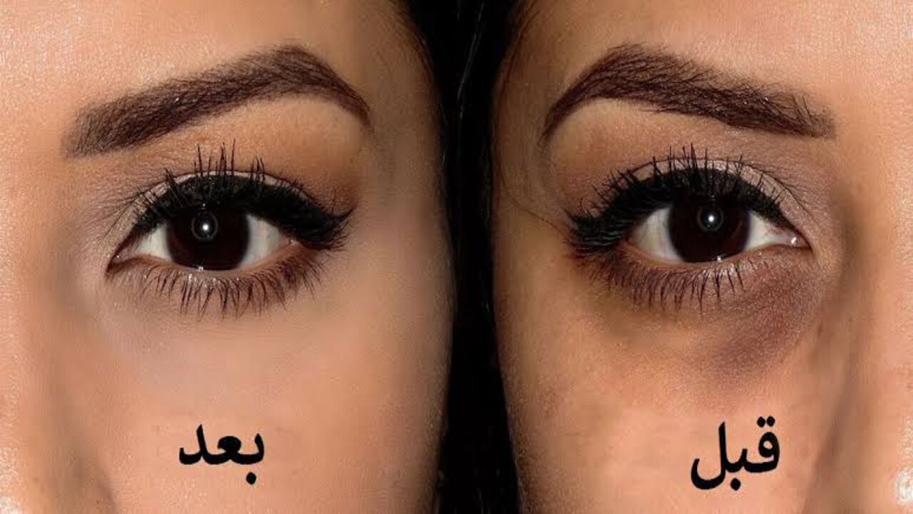 الخميرة للتخلص من الهالات السوداء