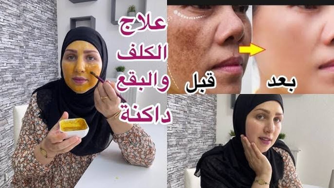 جل الالوفيرا لعلاج الكلف