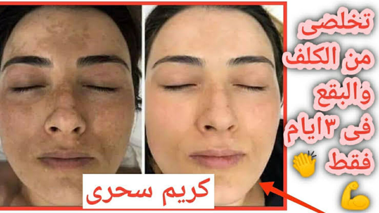وصفة جل الالوفيرا لعلاج الكلف