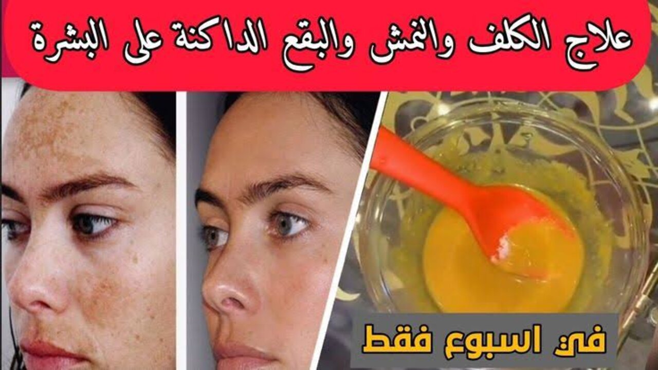 عشبة الليل لعلاج الكلف