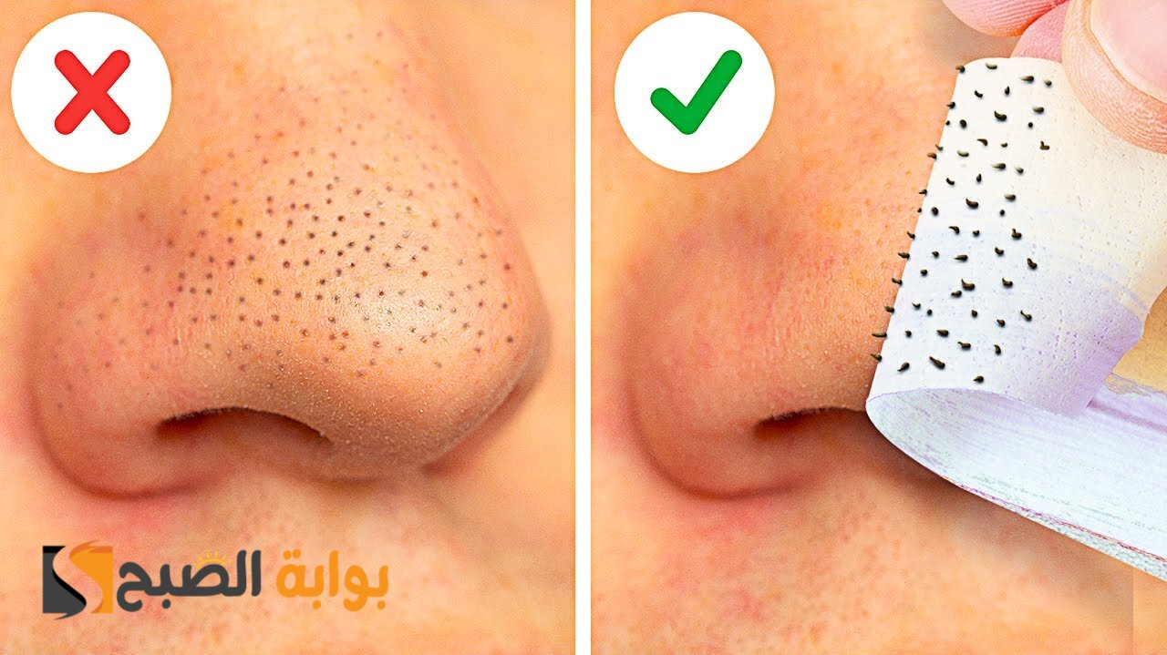 أفضل وصفات للتخلص من الرؤوس السوداء