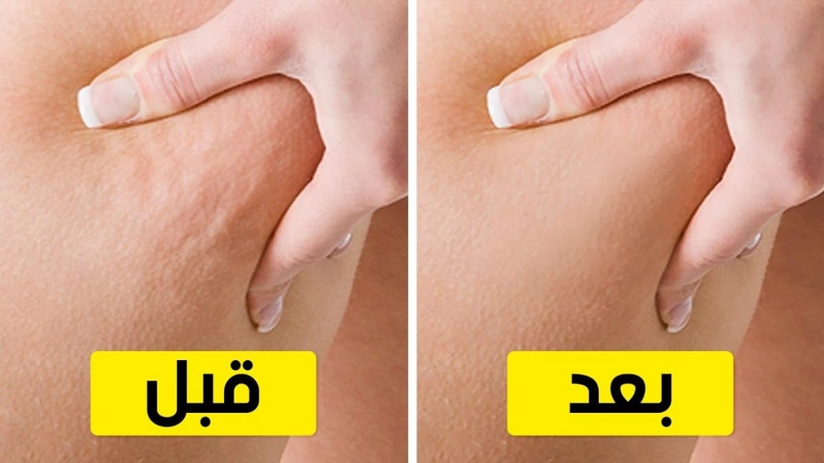 طرق التخلص من السيلوليت