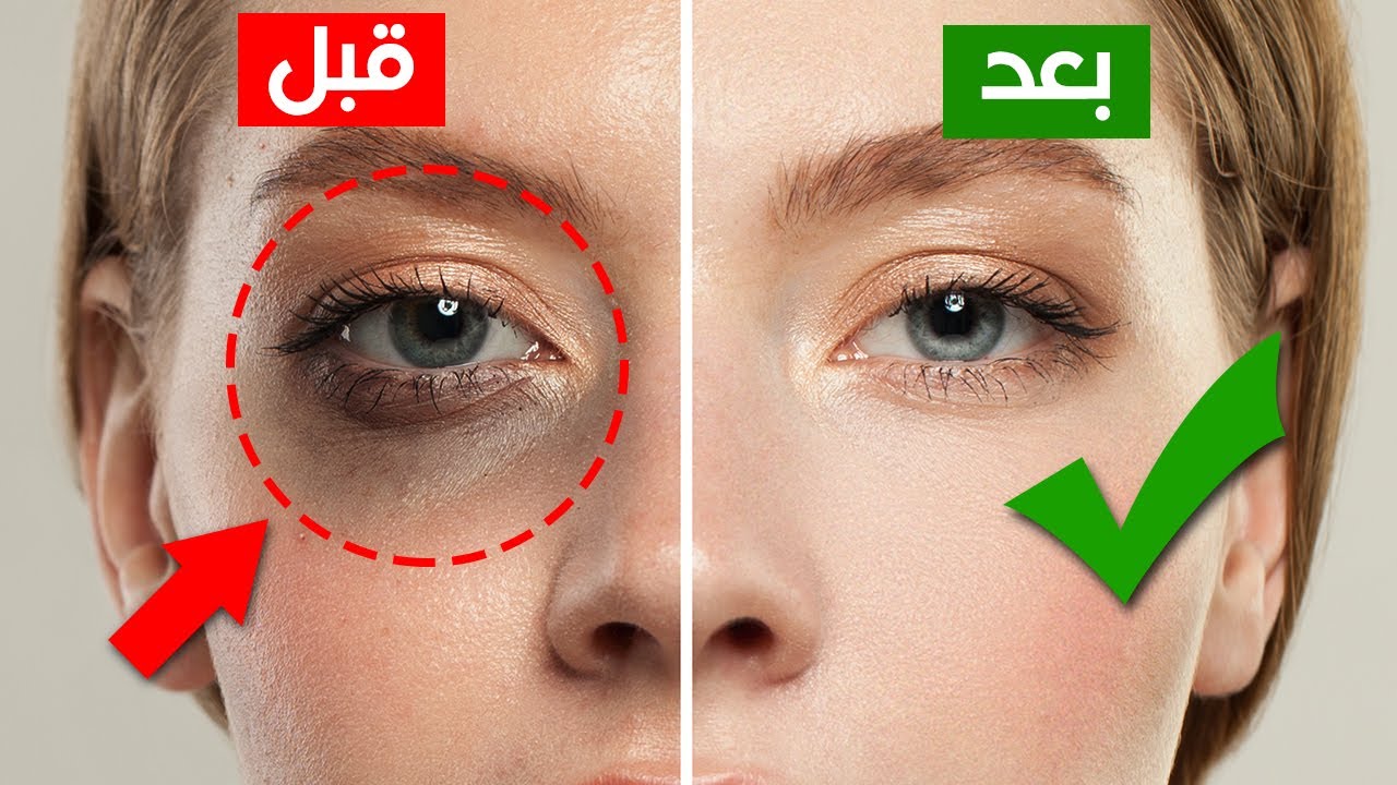 الهالات السوداء
