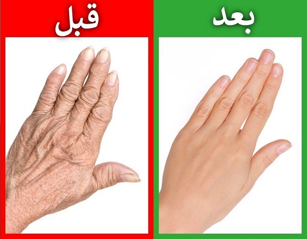 أفضل وصفة على الإطلاق لليدين الجافة والمتجعّدة