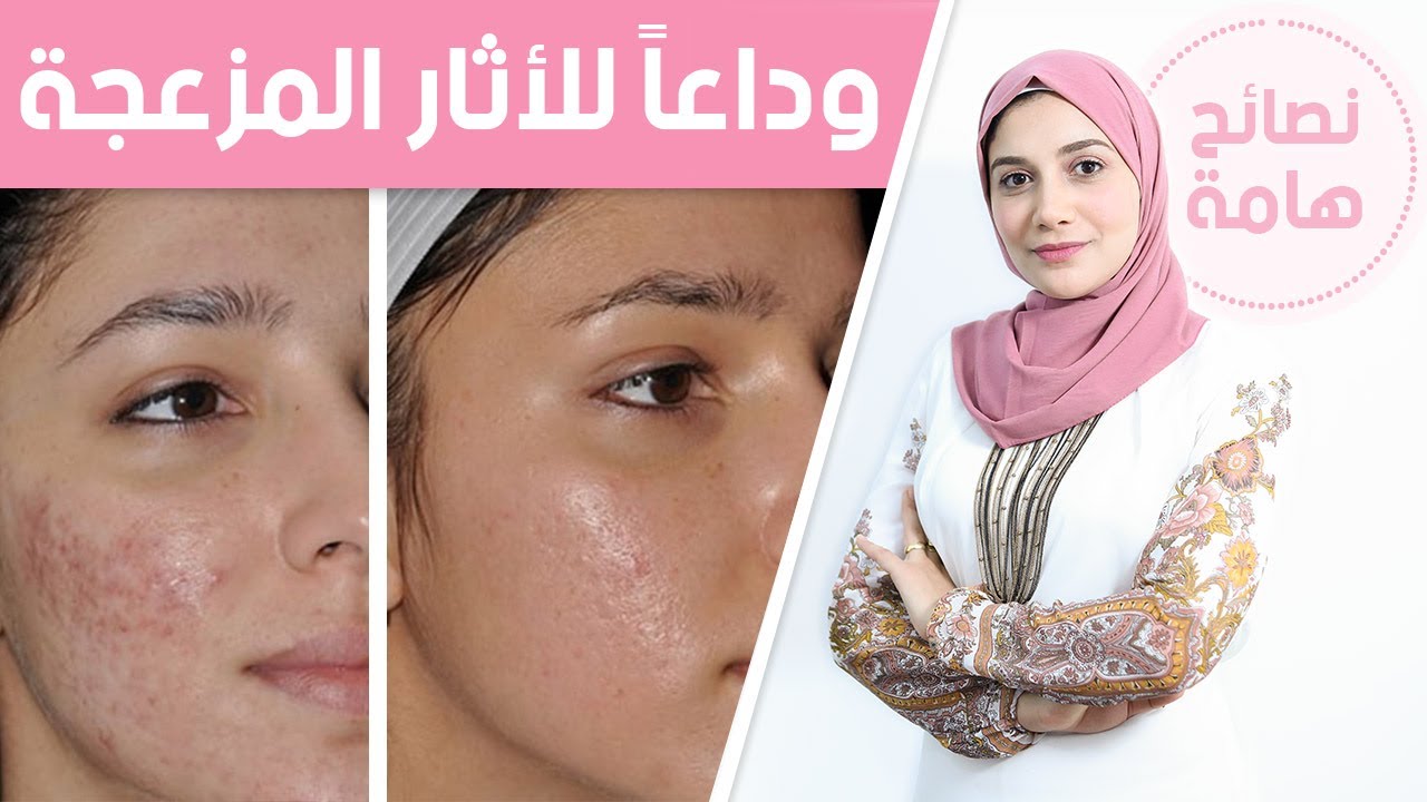 التخلص من آثار حب الشباب