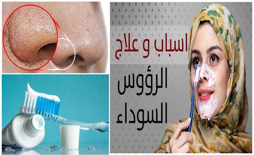 التخلص من الرؤوس السوداء