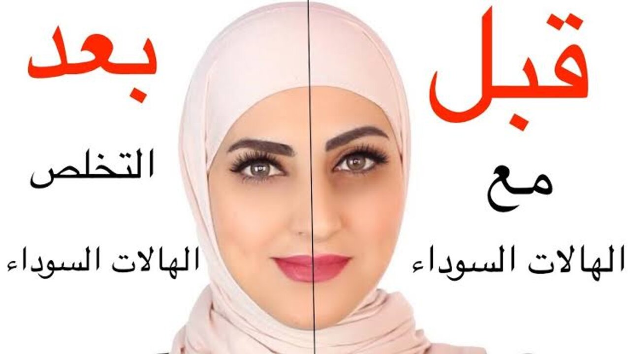 التخلص من الهالات السوداء
