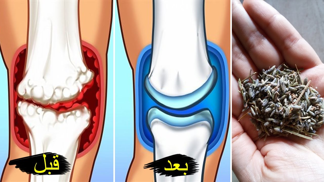 علاج التهاب المفاصل