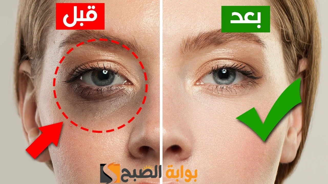 الوصفات الفعالة والمعالجة لإزالة الهالات السوداء