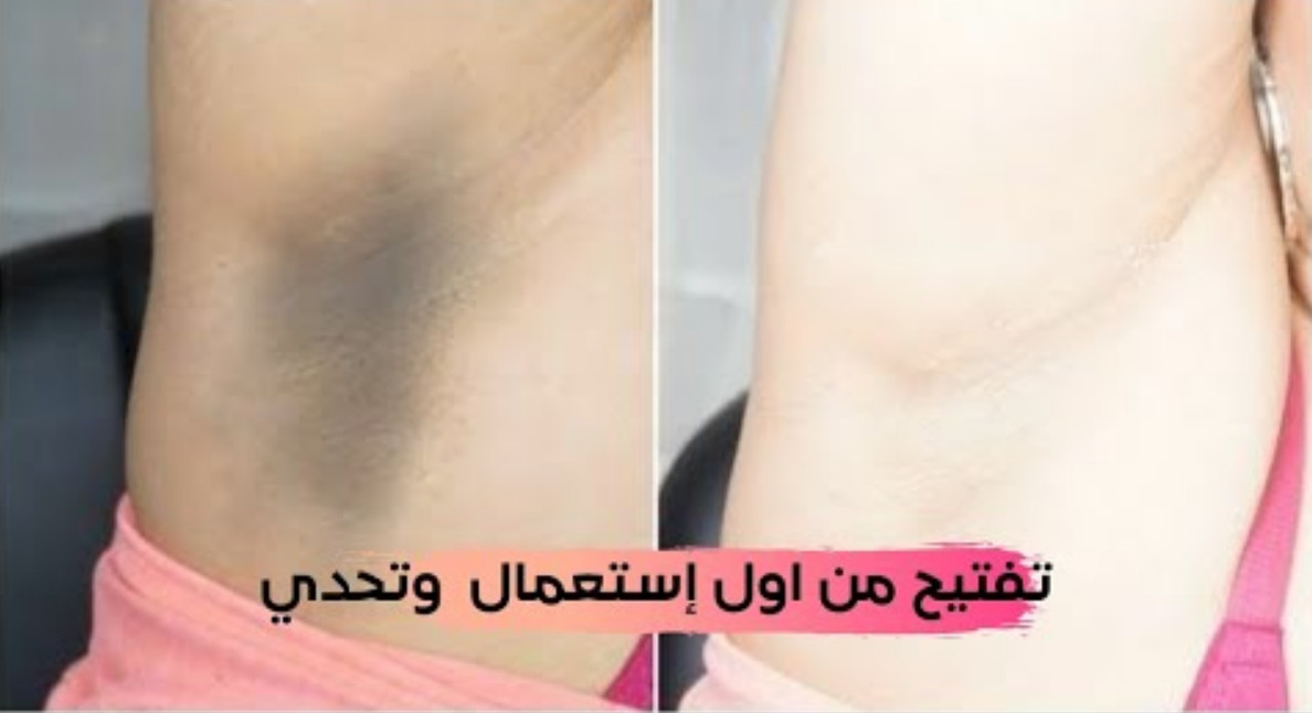 تبييض الإبطين6