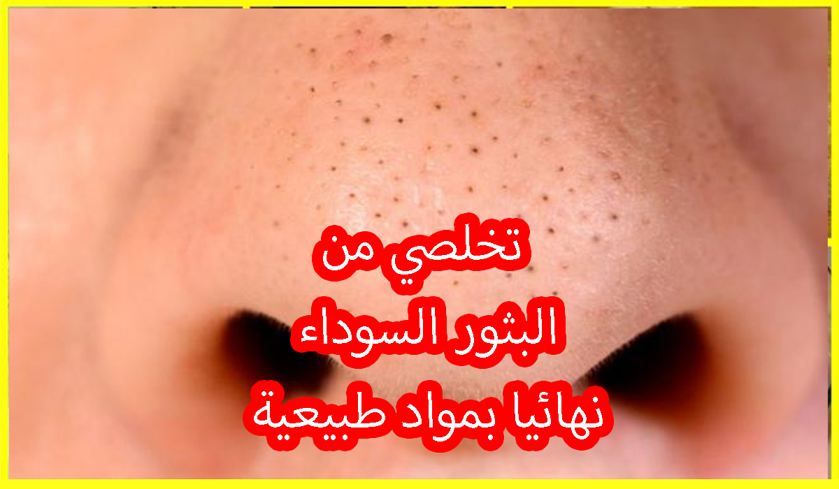 تخلصي من البثور السوداء