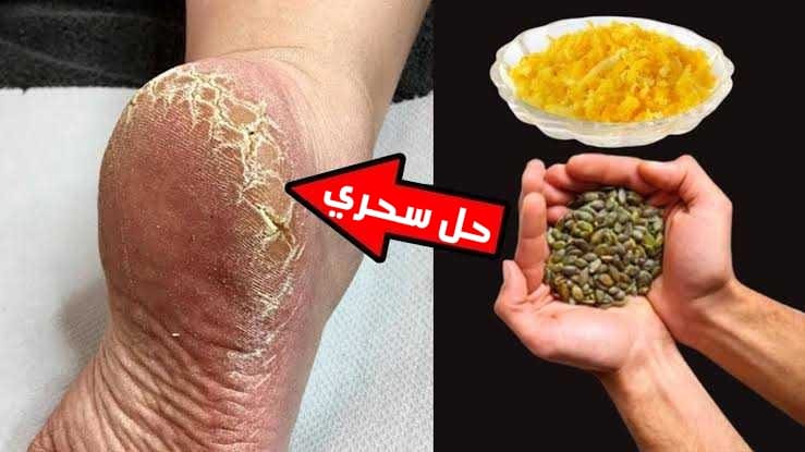 تشققات الكعبين والقدمين