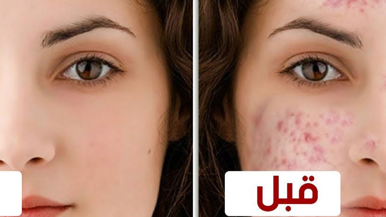 وصفات طبيعية للتخلص من حب الشباب