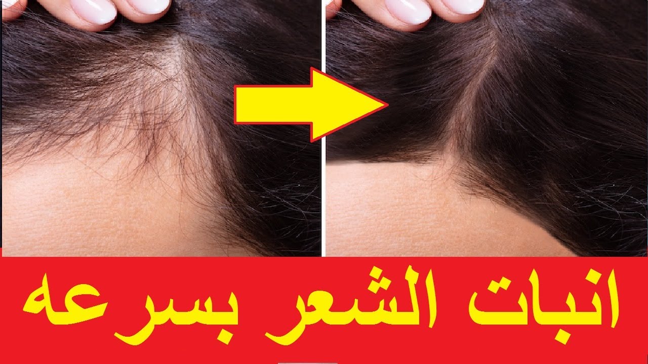 خلطة انبات الشعر ومقدمة الرأس