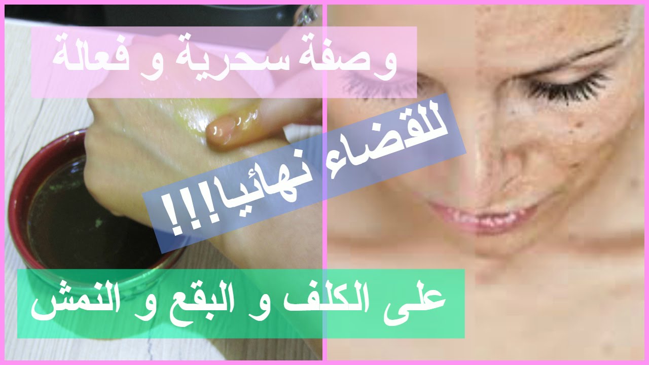 خلطة لإزالة الكلف والنمش نهائياً