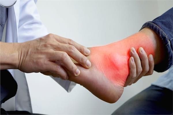 طرق علاج النقرس بالليمون