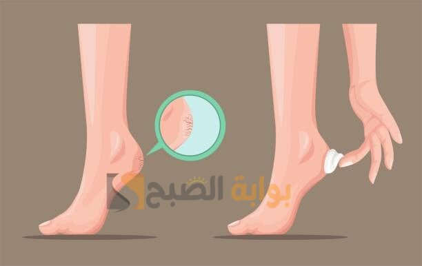 طريقة التخلص من تشققات القدمين والعناية بهم