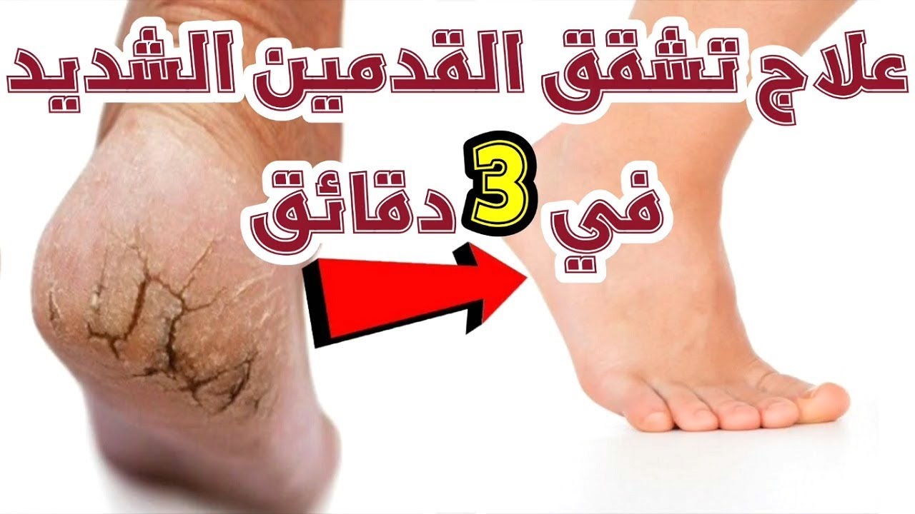 طريقة عمل كريم الجلسرين والليمون لعلاج تشققات القدمين