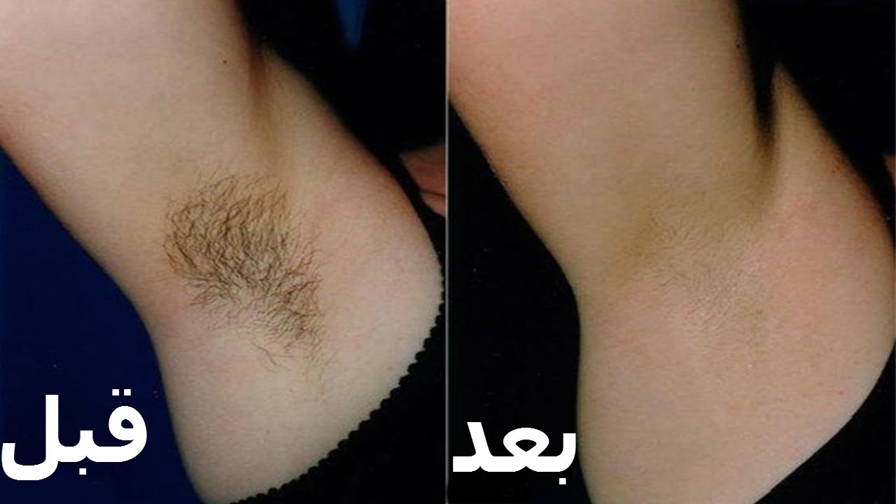 طريقة عمل كريم القرنفل والنشا لإزالة الشعر من الجسم بطريقة رهيبة