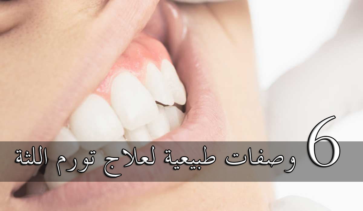 علاج التهاب اللثة في المنزل