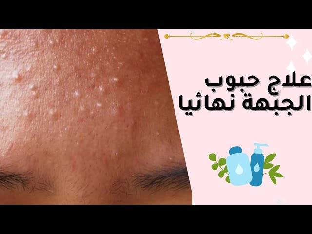 علاج الحبوب تحت الجلد